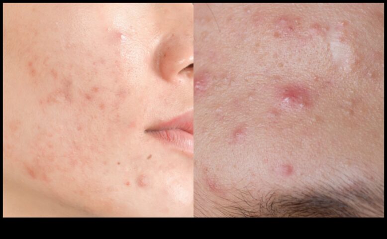 Πούδρα και ακμή Ένας οδηγός για τον έλεγχο της λάμψης χωρίς επιβαρυντικές κηλίδες